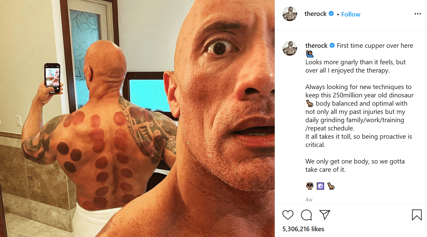 Cupping: Good for pro wrestlers, good for me?